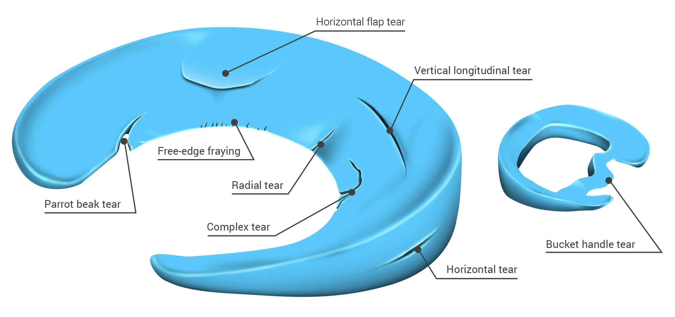 Meniscus Taer