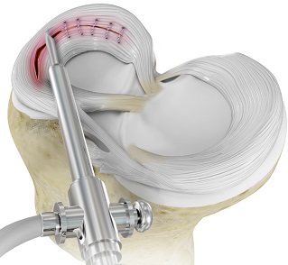 Arthoscopy Happy Joints