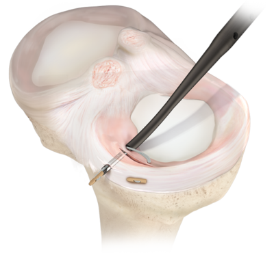 Arthoscopy Happy Joints