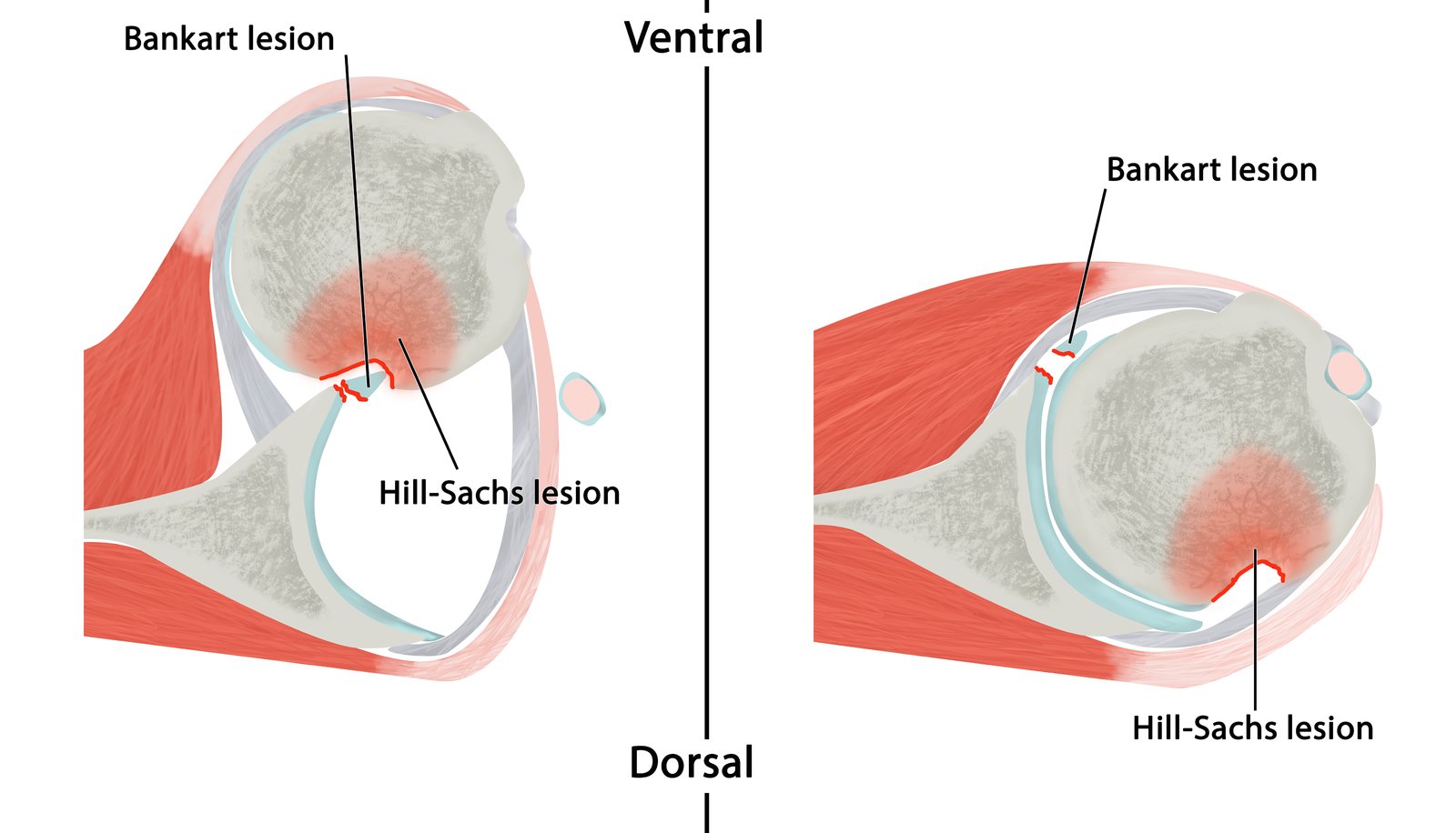 Shoulder_Dislocation
