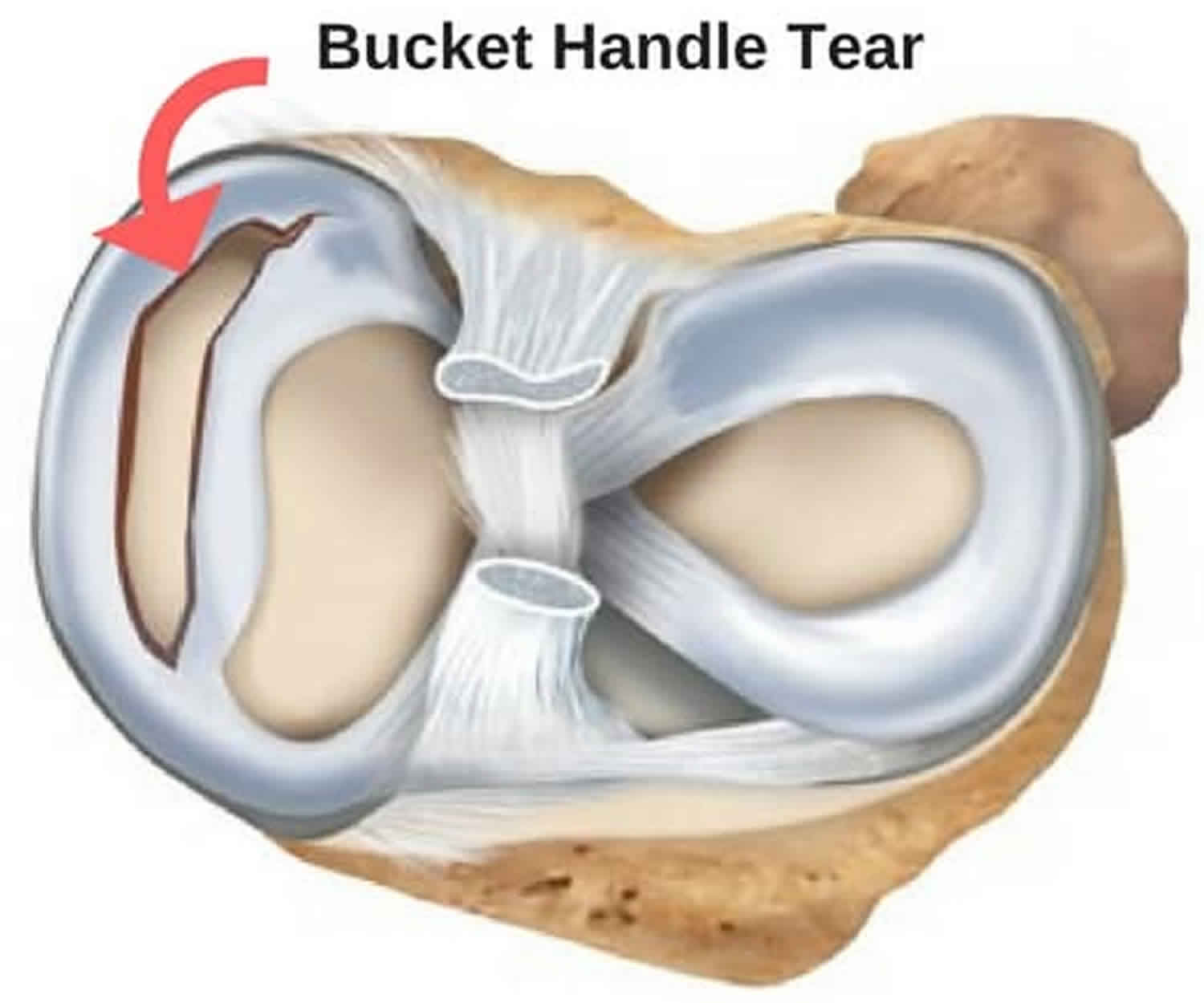 bucket-handle Happy Joints