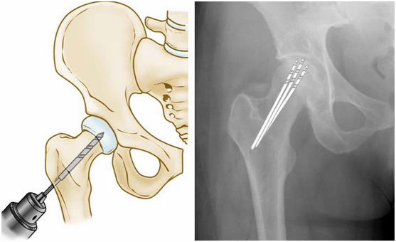 Happy_Joints_core_Decompression