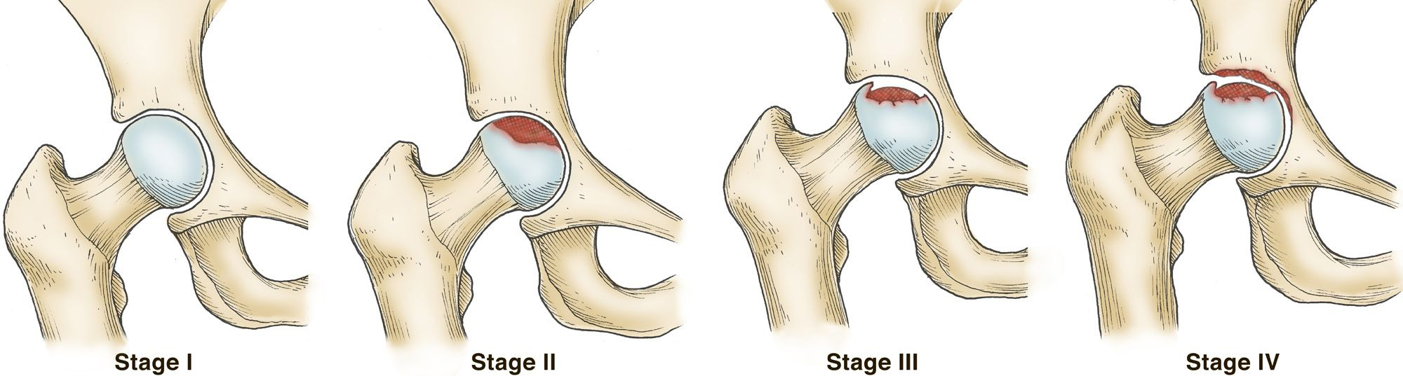 Happy_Joints_core_Decompression