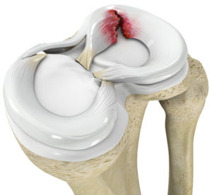 Miniscus Tear