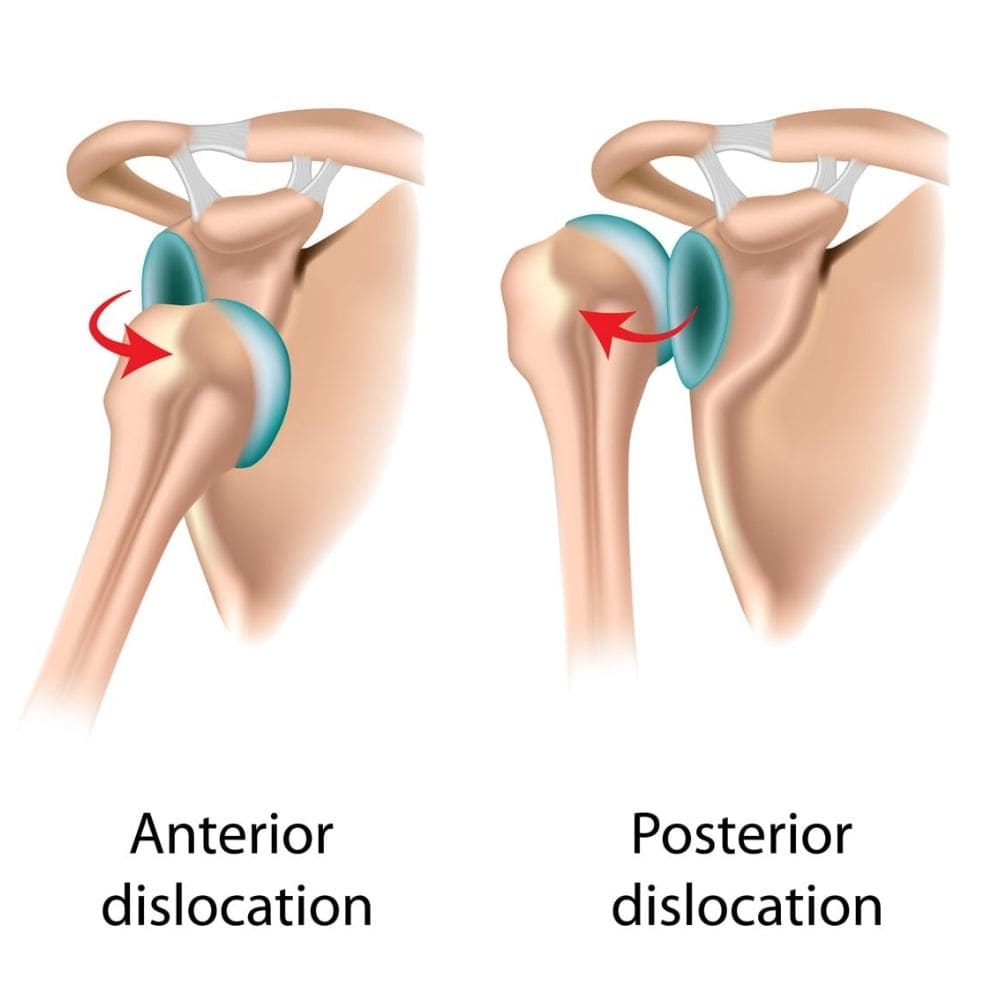 Shoulder_Dislocation