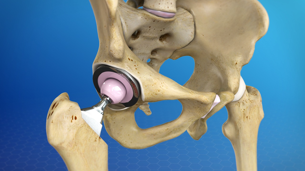 What is Hip Replacement Surgery Happy Joints