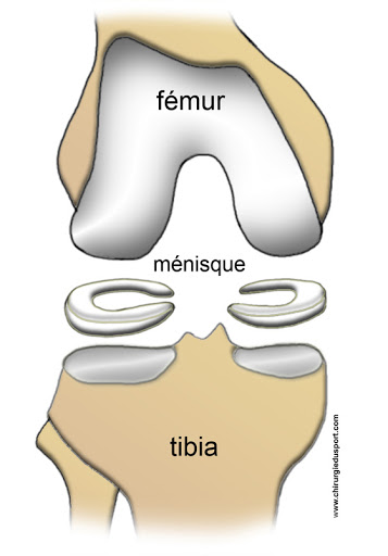 Miniscus Tear