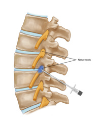 Nerve Root Block