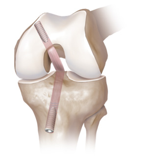 PCl Surgery Procedur